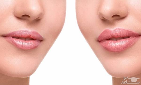از بین بردن ژل یا چربی تزریق شده