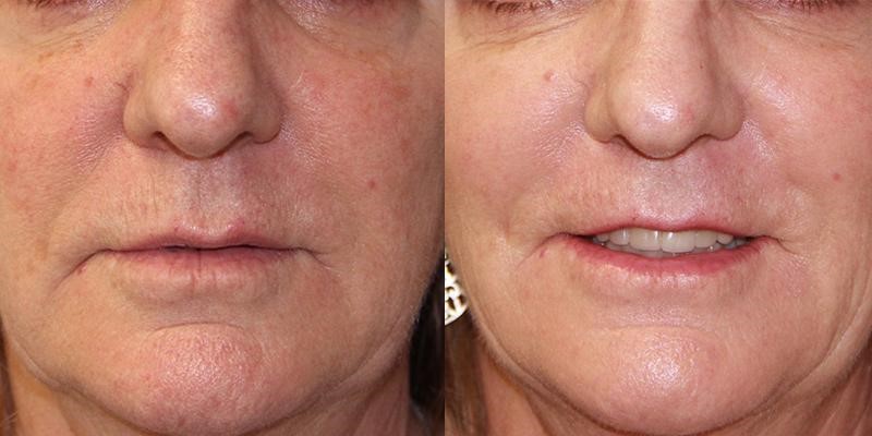 آیا در اجرای شیوه ی جوانسازی میکرونیدلینگ، امکان زخم شدن پوست صورت وجود دارد؟
