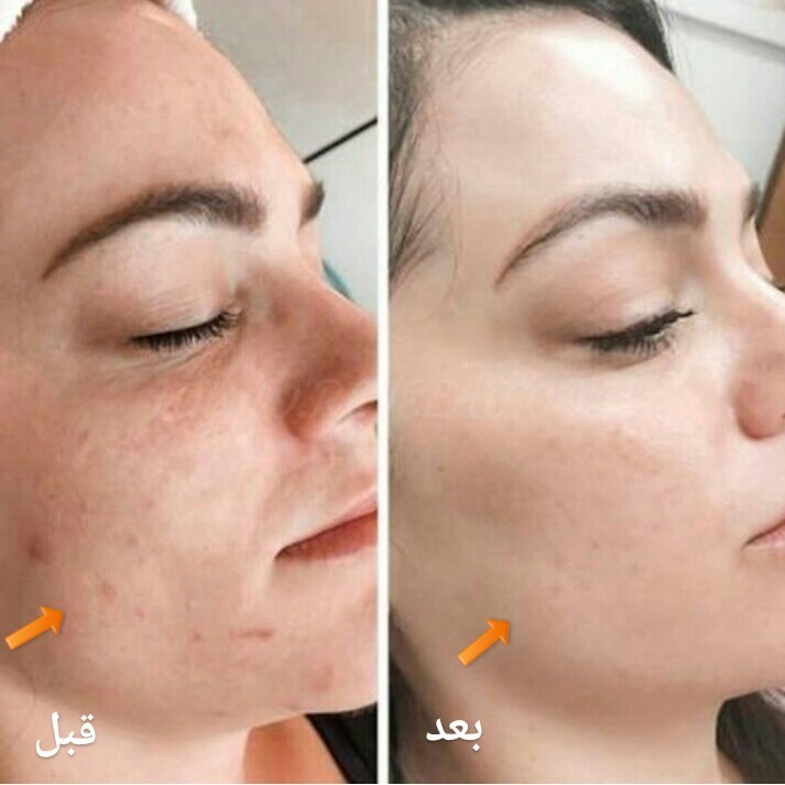 مزوتراپی روشی است که هدف آن استفاده کردن از سوزن های ریز برای رسیدن به لایه میانی پوست شما است