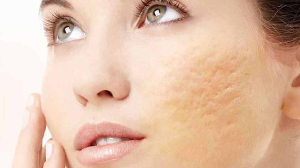 از بین بردن اسکار با لیزر به چه صورت است؟