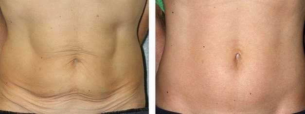 اثرگذاری کربوکسی تراپی چگونه است؟