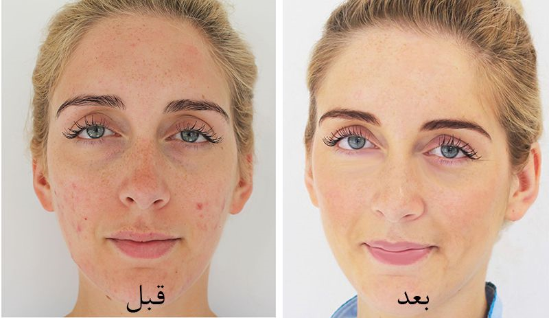 هزینه لیزر اسکار چگونه برآورد میگردد؟