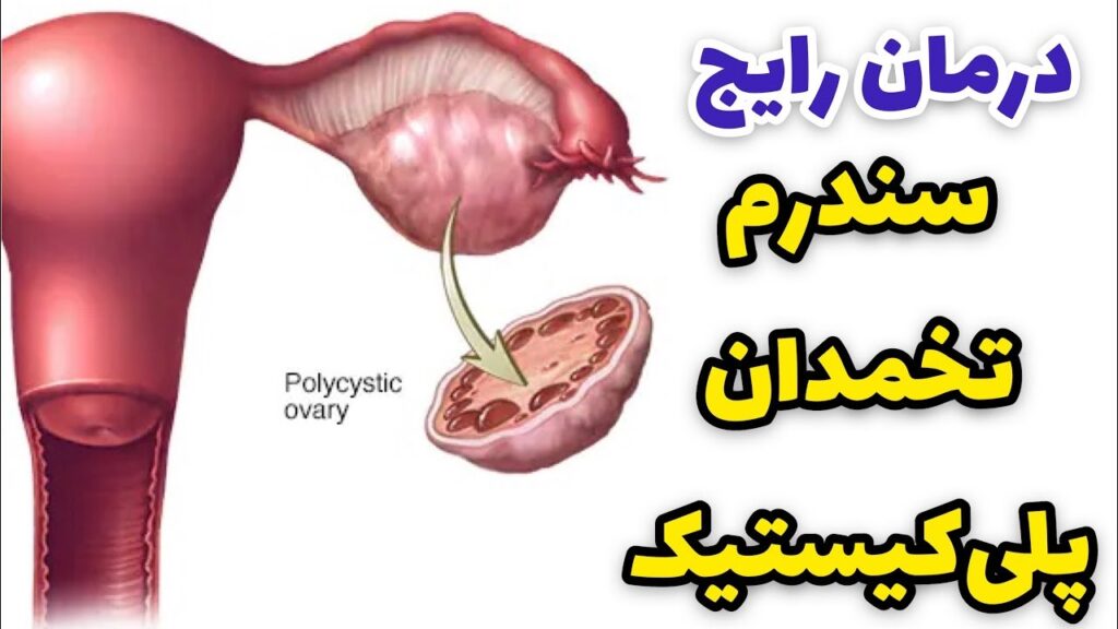 تنبلی تخمدان مشتمل بر تعداد بسیاری از کیست های از حد معمول بزرگتر است