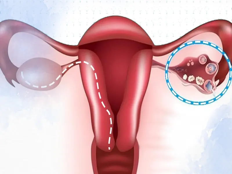 رابطه PCOS و نازایی