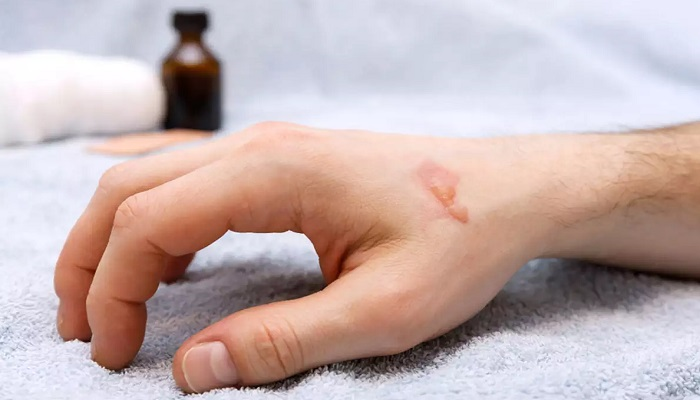 از بین بردن جای سوختگی با لیزر