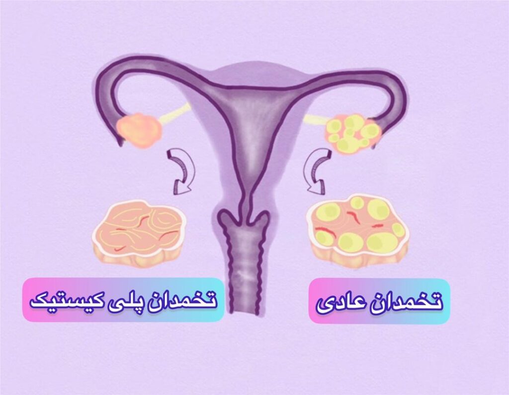 نوع شدید این عارضه تنها با هدف تغییر در شیوه زندگی معالجه نمی شود