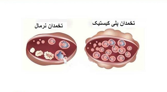 آیا تنبلی تخمدان باعث نازایی میشود