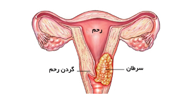 سرطان گردن رحم