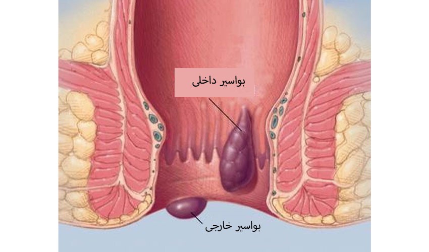 افراد زیادی تا قبل از سن 50 سالگی به این بیماری مبتلا می شوند