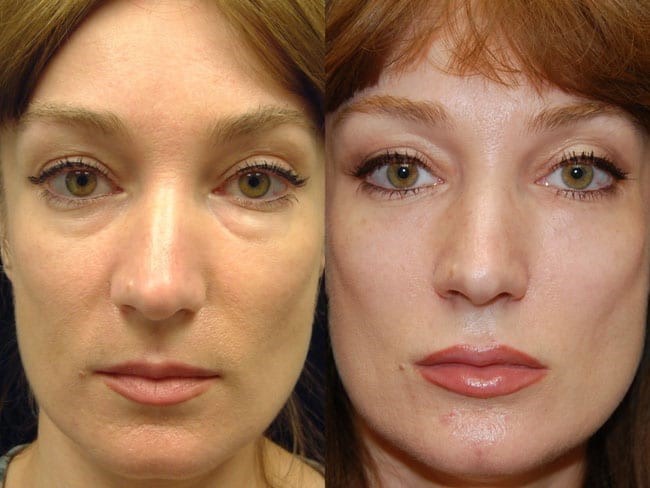 مزوتراپی لک های صورت به چه شکل است؟