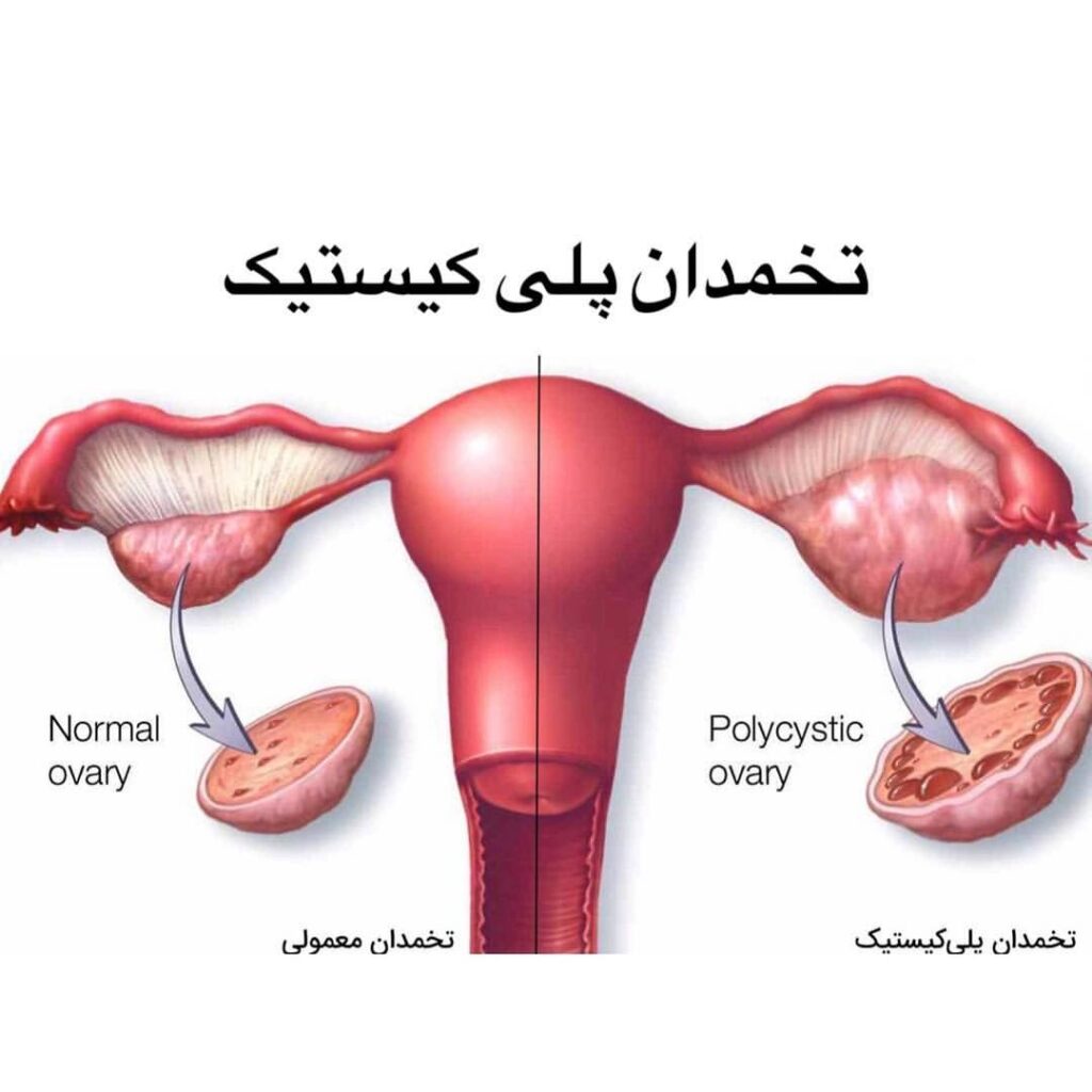 در واقع PCOS مشکل جنسی است که سبب ناباروری در بانوان میشود