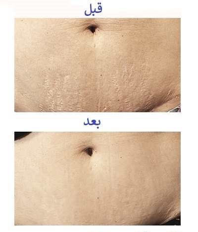 عکس قبل و بعد کربوکسی تراپی