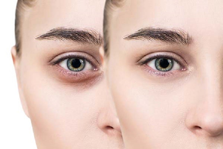 عکس قبل و بعد کربوکسی تراپی