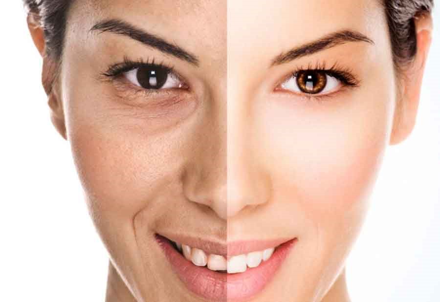 عکس قبل و بعد کربوکسی تراپی