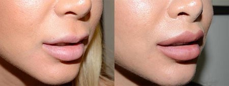 رفع چروک های پوستی با استقامت بسیار پوست روبرو است