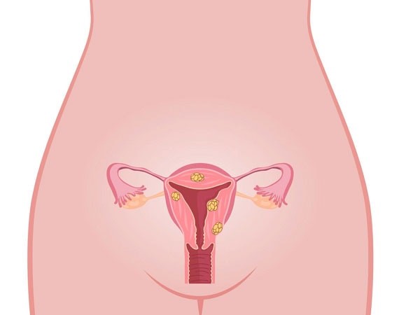 آیا میدانید علائم پیشرفتهتر تنبلی تخمدان شامل چیست؟